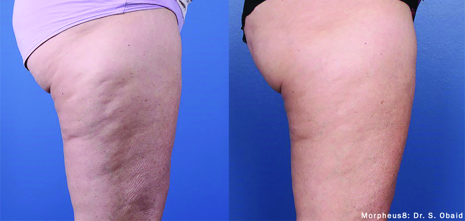 Morpheus8_Before&After (5)