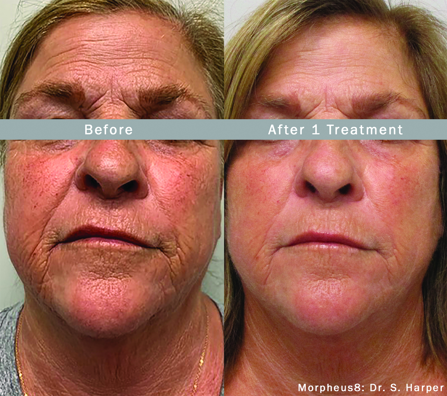 Morpheus8_Before&After (6)